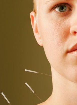 acupunctures