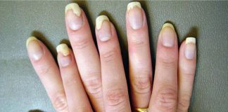 Home Remedies for Yellow Nails