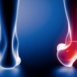 Home Remedies For Sprained Ankles
