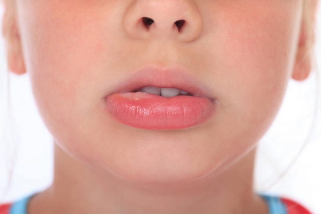 Home Remedies For Swollen Lips