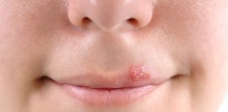8 Home Remedies for Fever Blisters