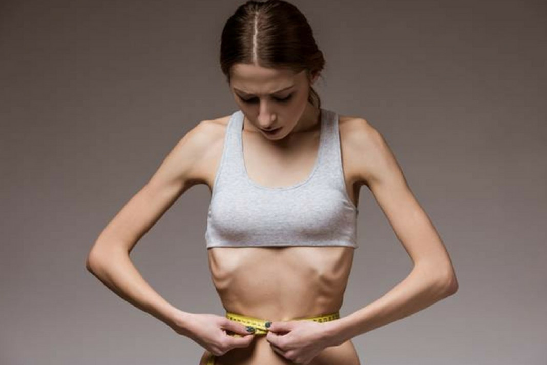 Home Remedies for Anorexia