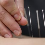 Acupressure vs. Acupuncture - Things You Must Know